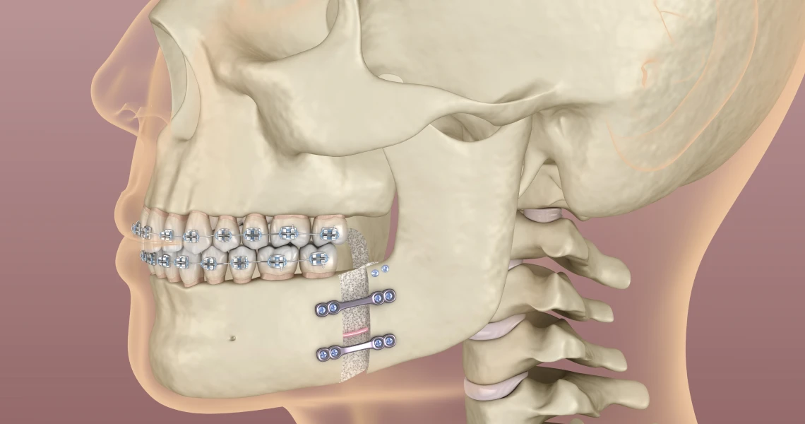 Suivi orthodontique au cabinet des Bruyères des Docteurs Benichou & Nizard à Bois-Colombes (92270)