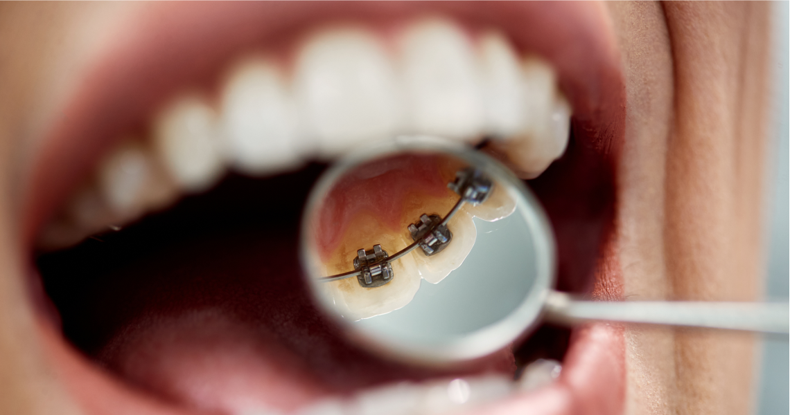 Orthodontie linguale
