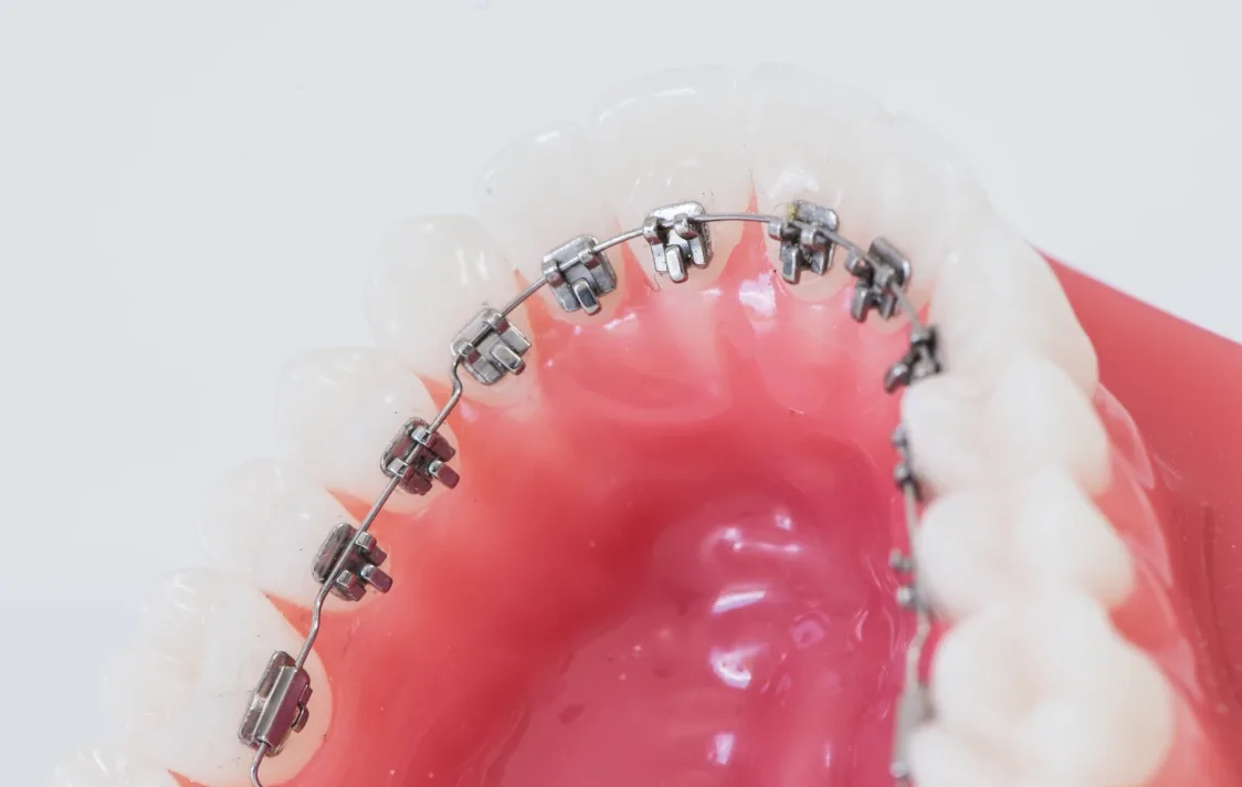 Modèle de démonstration d’une arcade avec attaches linguales collées sur la face interne des dents